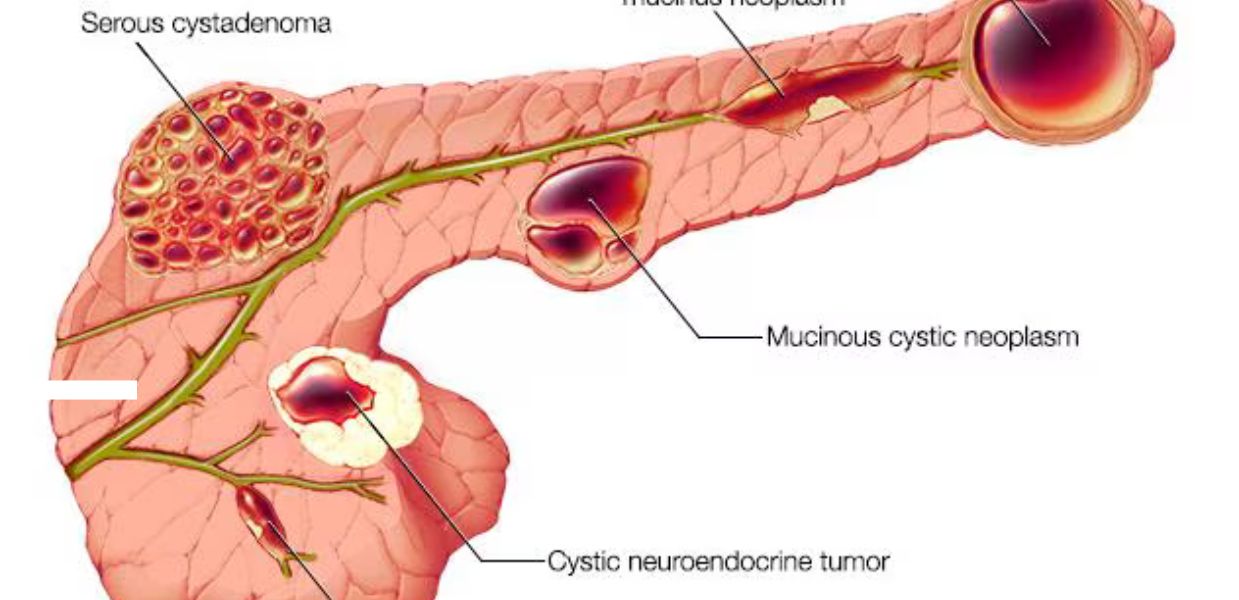 Pancreatic Pseudocyst Surgery: Treatment in India